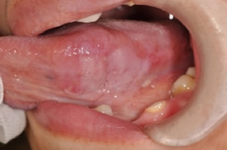 早期の口唇がん、口腔がんに対する密封小線源治療1"